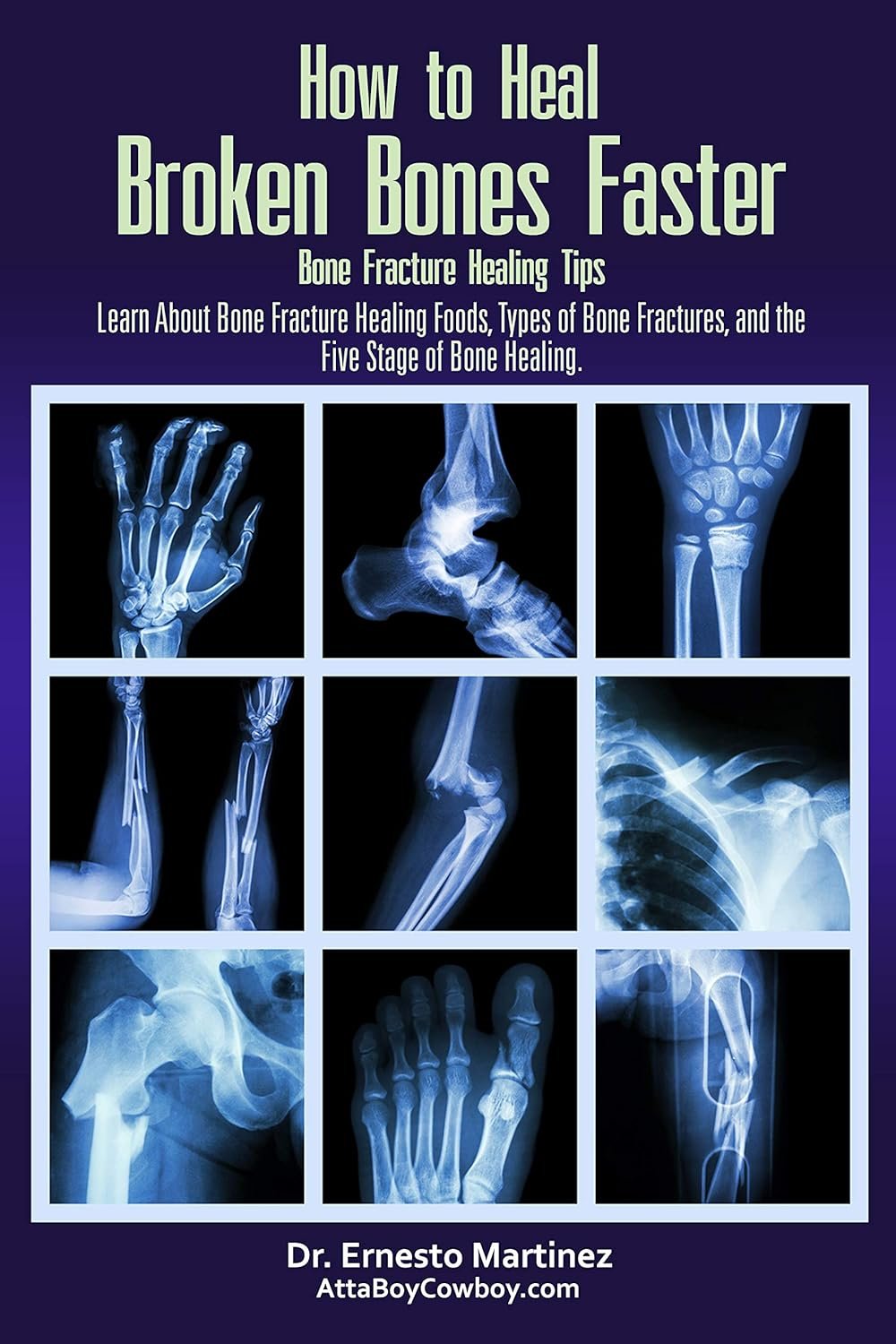Bone Healing Secrets: Recover Faster After Injury