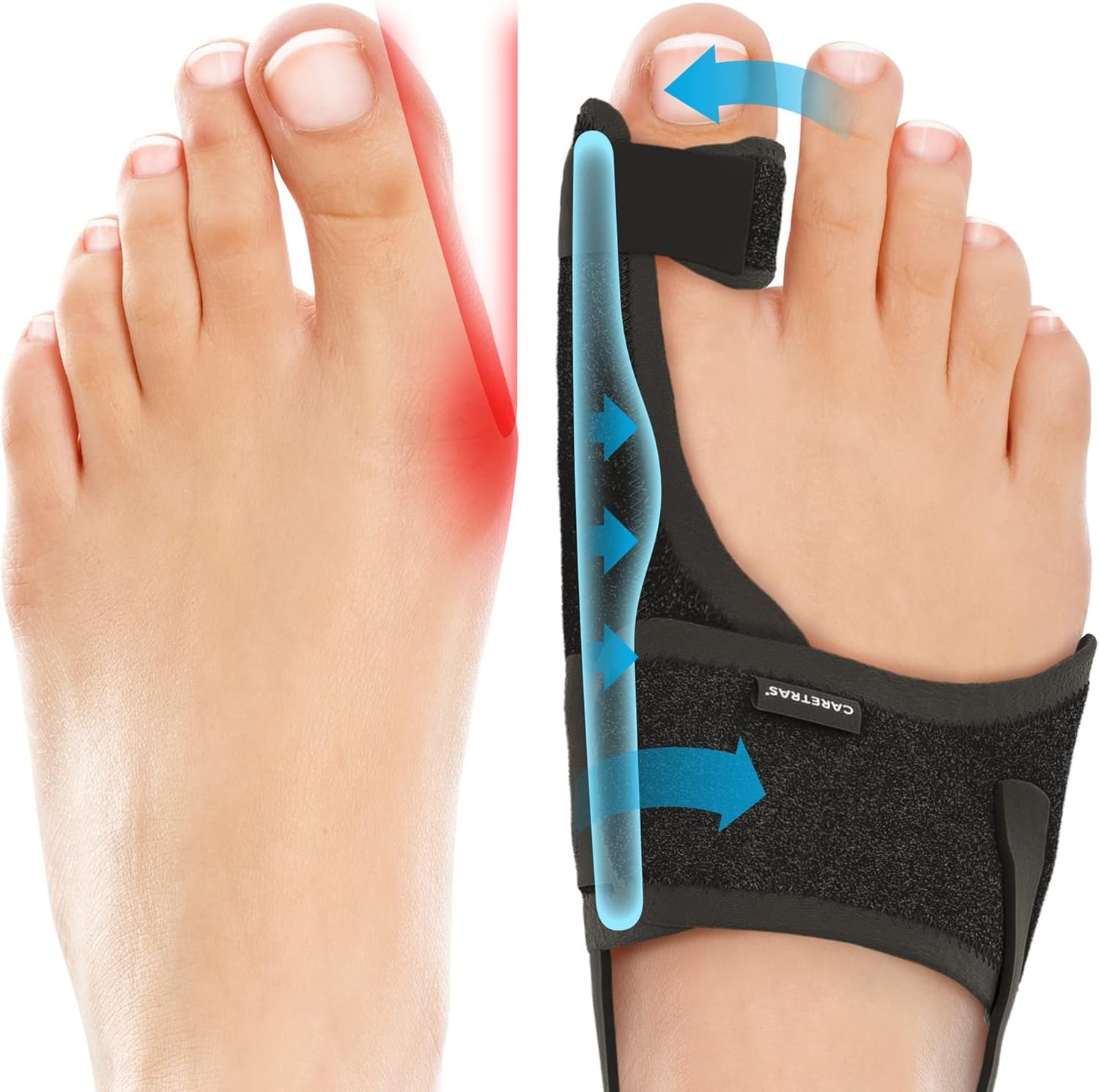 Bunion Pain Relief: Adjustable Orthopedic Toe Corrector