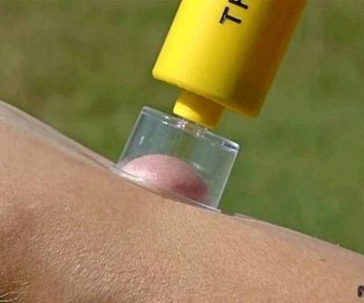 Bite & Sting Extractor Kit