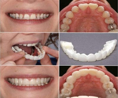 Instant Confidence: Temporary Teeth Cover for a Natural Smile